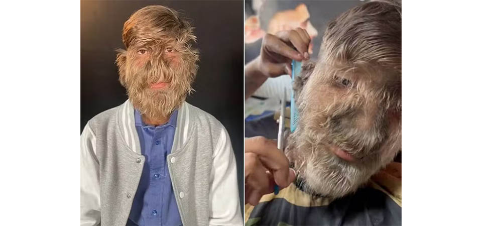 'Síndrome de lobisomem': jovem com o rosto mais peludo do mundo vira influencer e revela as dificuldades do dia a dia