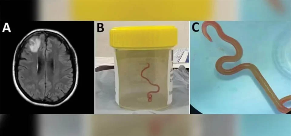 Verme parasita de cobra é encontrado pela 1ª vez no cérebro de humanos