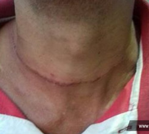 Sorriso: linha de pipa com ceról deixa motociclista ferido