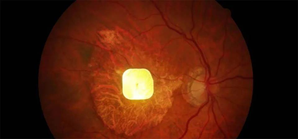 Chip implantado na retina devolve visão a pacientes cegos