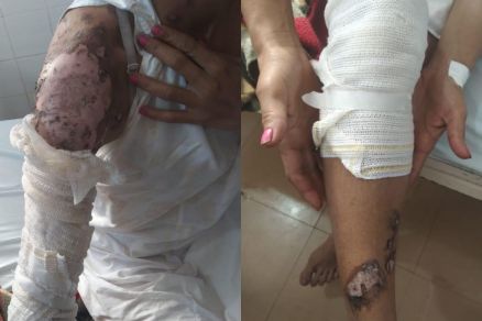 Mulher é jogada na fogueira pela amante do marido