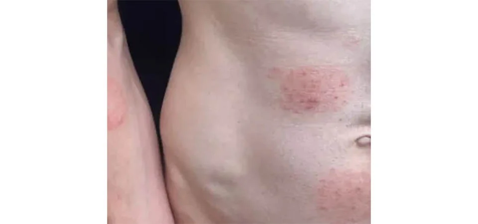 Verme ‘altamente contagioso’ transmitido por via sexual gera alerta em diversos países