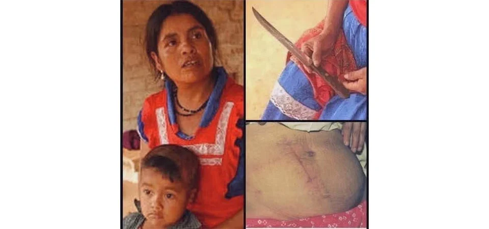 Com uma faca comum, sem anestesia, ela abriu a própria barriga e fez a cesariana em si própria