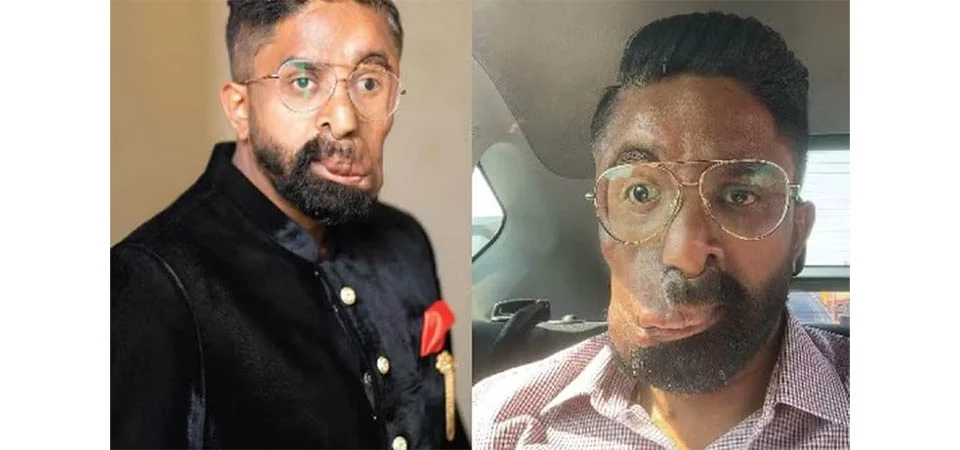 Homem que sobreviveu a tumores no rosto e virou coach diz que cafeteria se negou a atendê-lo por causa da aparência