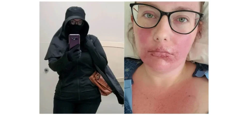 “Tenho que viver como uma vampira”, diz mulher com alergia ao sol