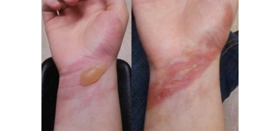 MT tem 4ª taxa de mortalidade por queimaduras térmicas; número aumentou na pandemia