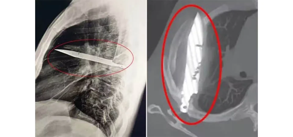 Homem reclama de dores nos mamilos, e médico descobre lâmina de faca alojada no seu corpo há oito anos