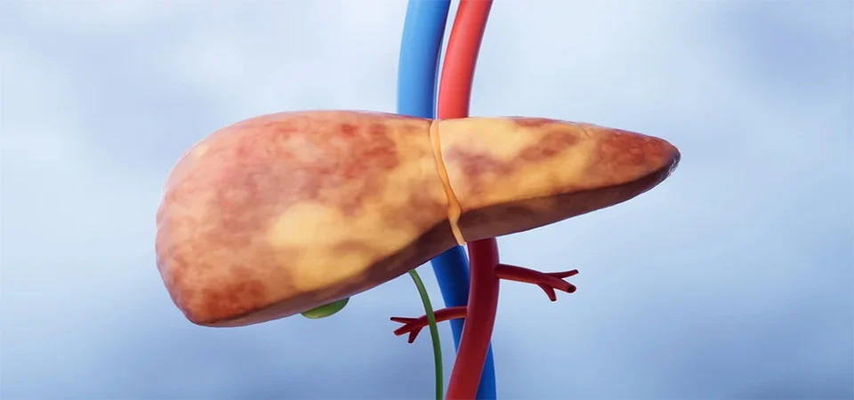 Hepatologistas citam riscos da gordura no fígado para a saúde em geral
