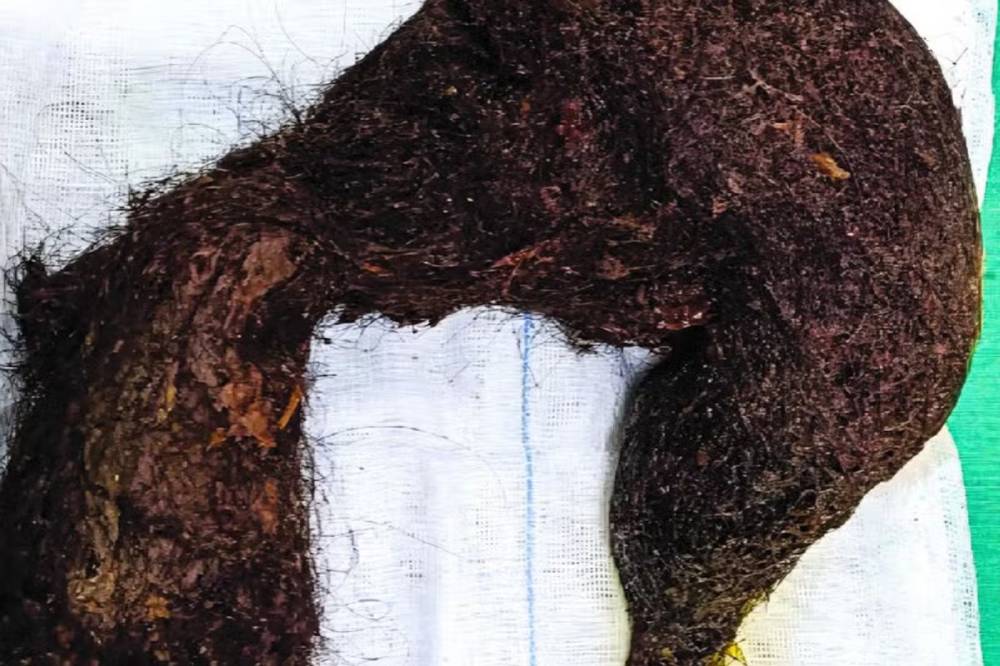 Internada com dores abdominais, mulher tinha bola de cabelo com mais de 1 kg em seu estômago