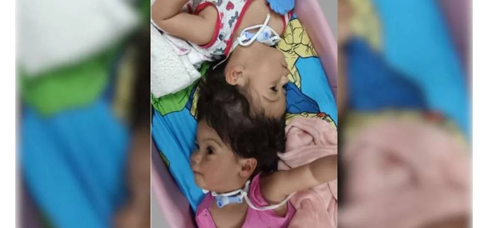 Gêmeas siamesas passam por 4ª cirurgia antes de separação definitiva
