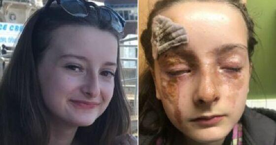 Garota fica com queimaduras graves após receita da internet