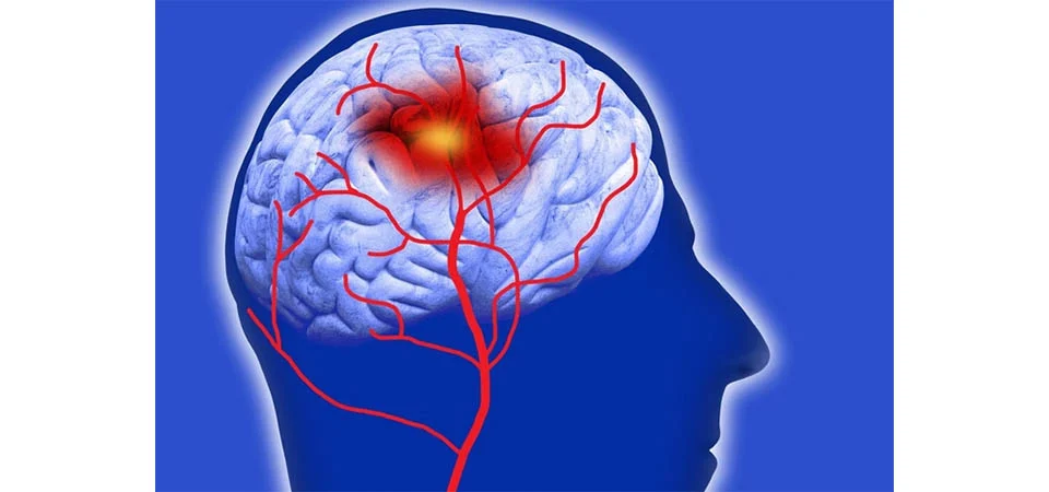 Adoçante usado em produtos “zero açúcar” pode aumentar risco de AVC