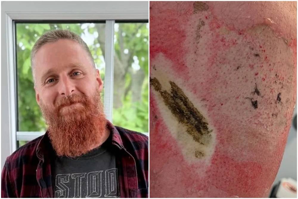 Homem sofre queimadura grave após bateria de vape explodir em bolso